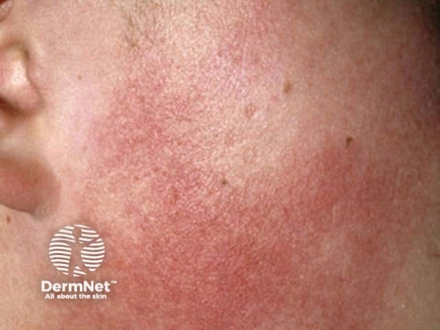 Keratosis pilaris atrophicans faciei