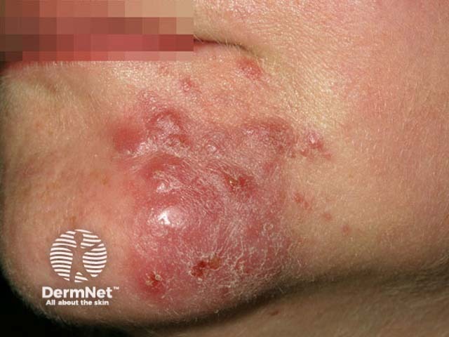 Pyoderma faciale, rosacea fulminans