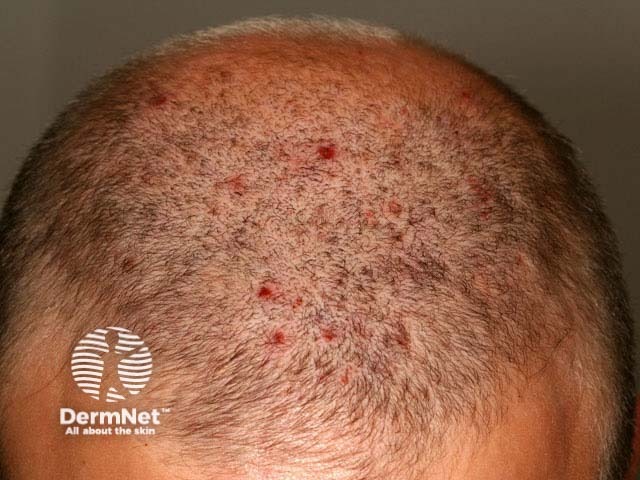 Scalp folliculitis