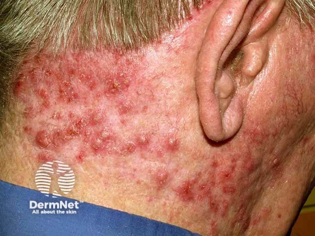 Scalp folliculitis