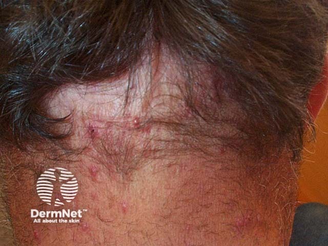 Scalp folliculitis