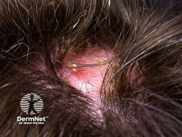 Scalp folliculitis