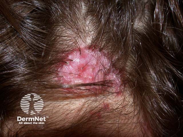 Scalp folliculitis