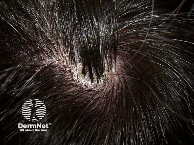 Scalp folliculitis