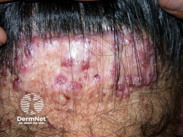 Scalp folliculitis