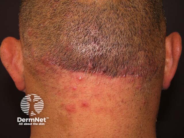 Scalp folliculitis