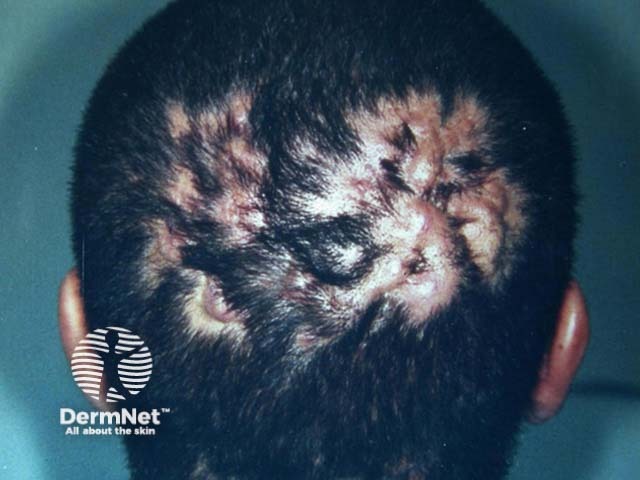 Scalp folliculitis