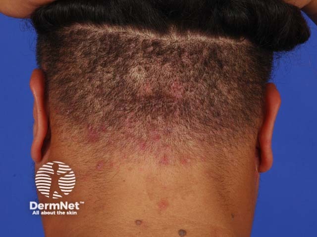 Scalp folliculitis