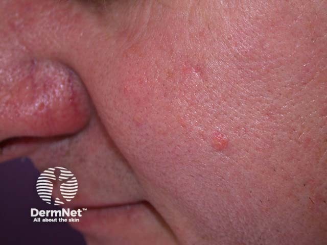 Sebaceous hyperplasia