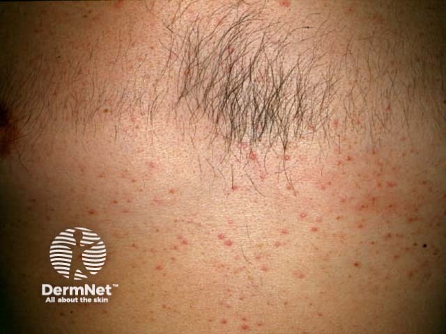 Steroid acne