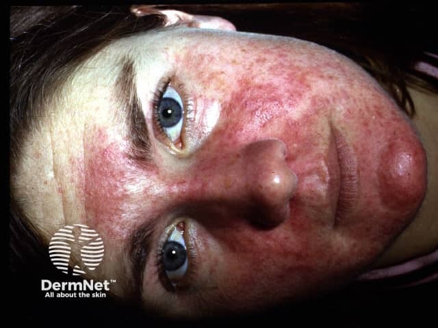 Steroid rosacea