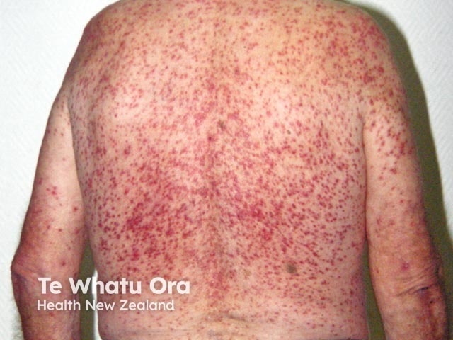 Steroid acne