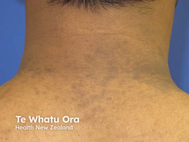 Acquired dermal macular hyperpigmentation