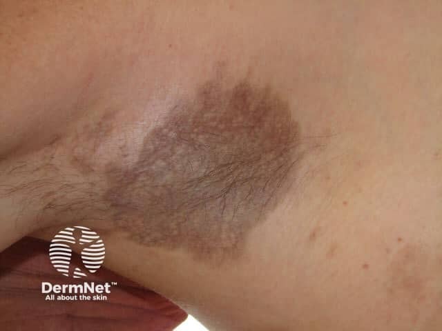 Erythema dyschromicum perstans