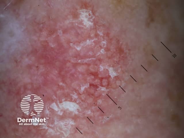 Dermoscopy of actinic keratosis