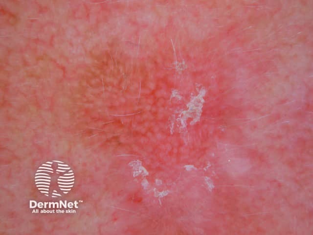 Dermoscopy of actinic keratosis