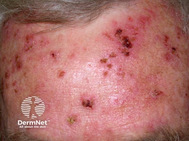 Actinic keratosis treated with fluorouracil cream