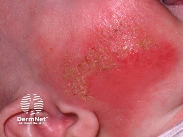 Acute eczema