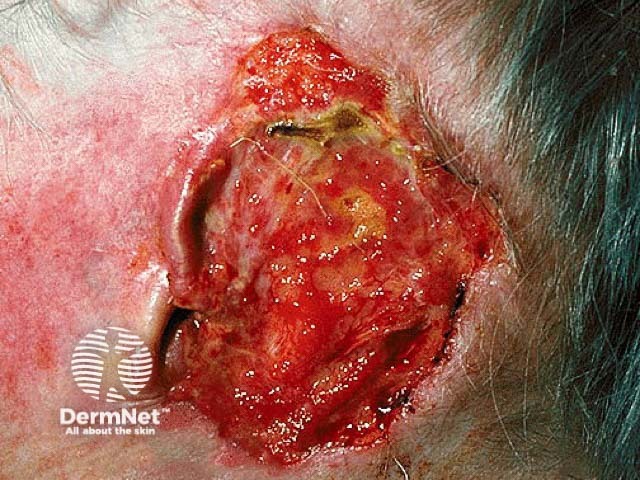 Advanced basal cell carcinoma