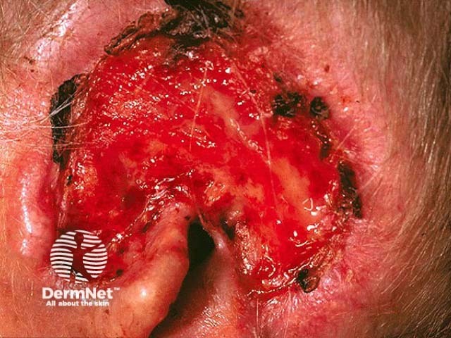 Advanced basal cell carcinoma