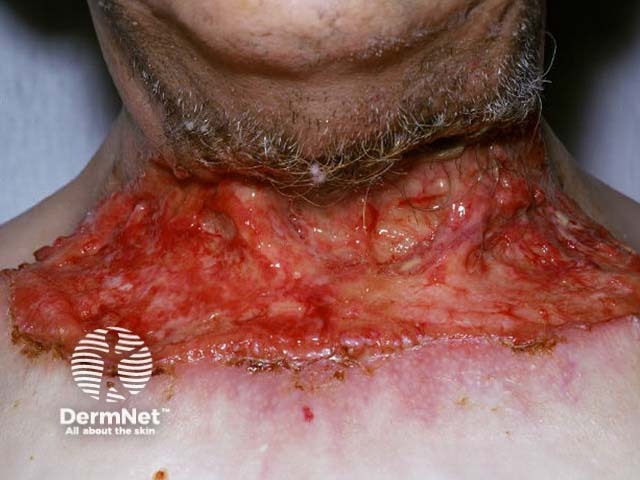 Advanced basal cell carcinoma