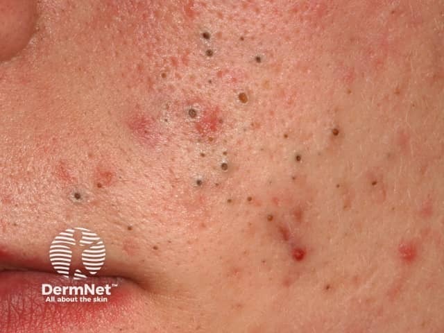 Comedonal acne