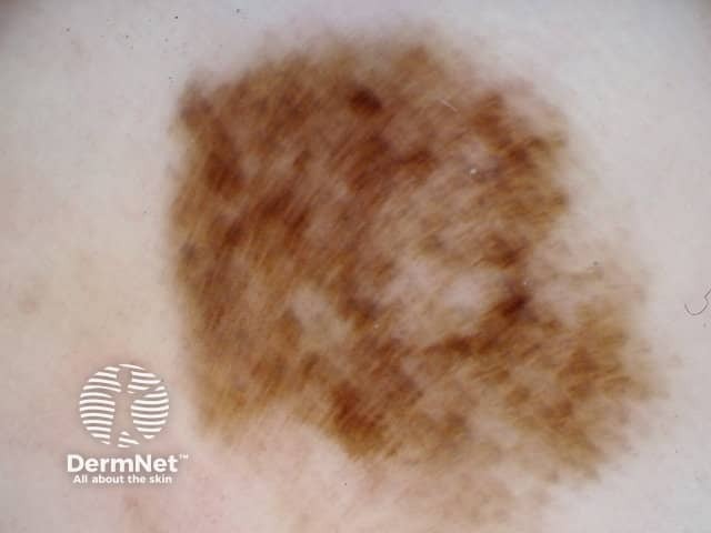 Acral lentiginous melanoma 4 dermoscopy