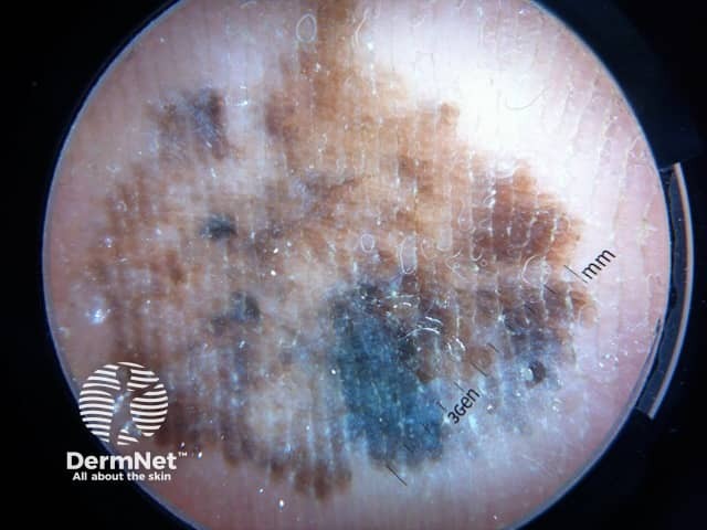 Dermoscopy of an acral lentiginous melanoma showing variable pigmentation and areas of regression