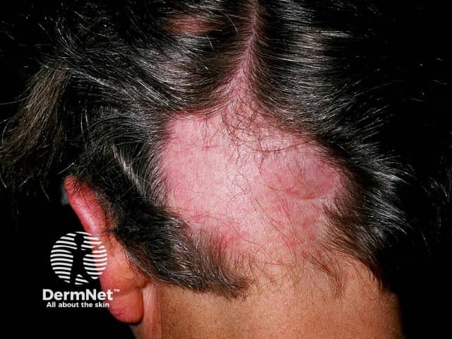 Alopecia areata