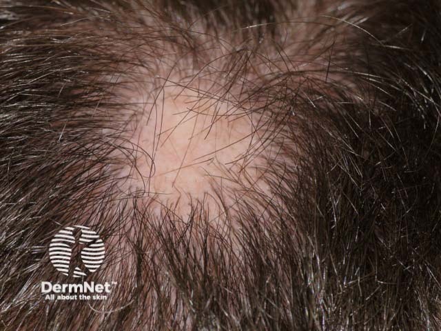 Alopecia areata