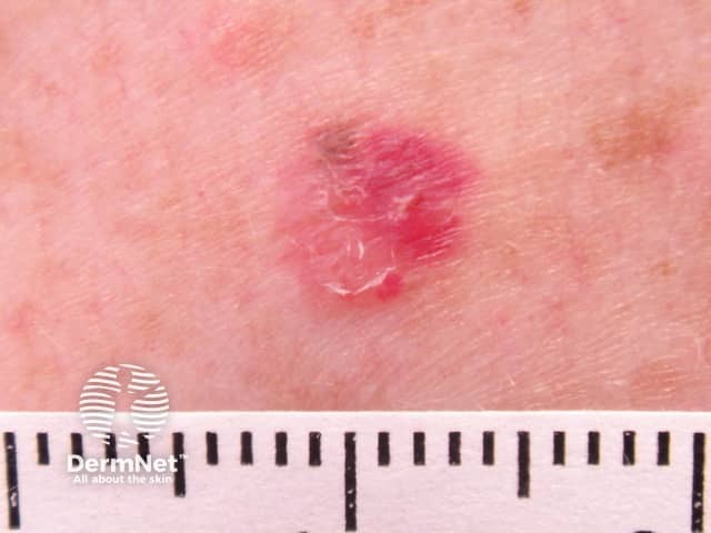 Amelanotic melanoma