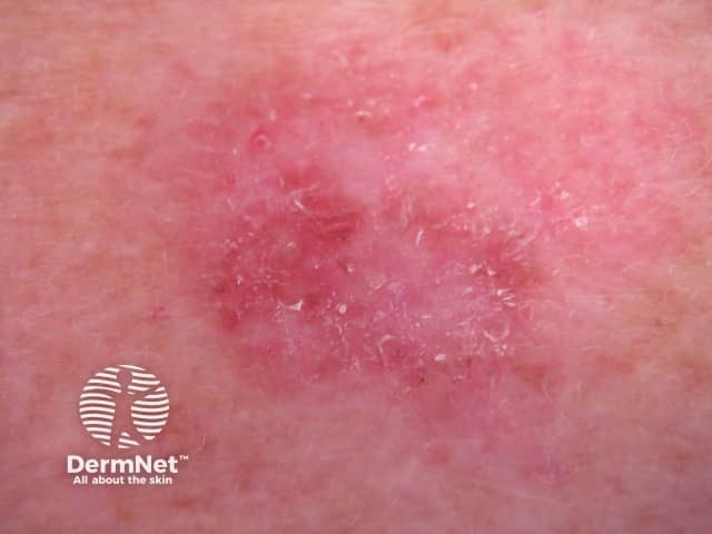 Amelanotic melanoma