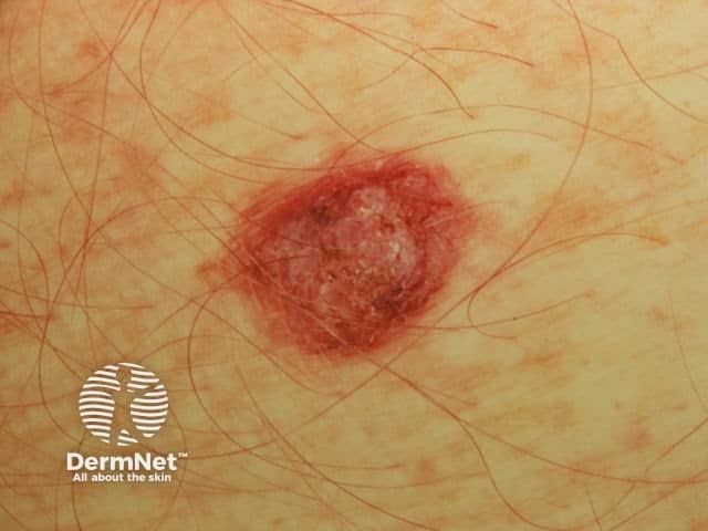 Amelanotic melanoma