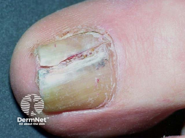 Subungual amelanotic melanoma of nail unit, toe