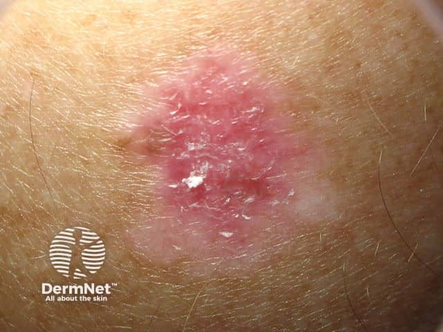 Amelanotic superficial spreading melanoma in situ