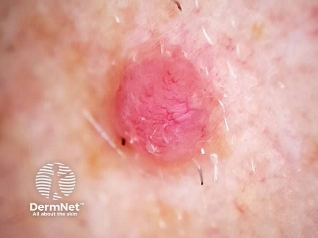 Nodular melanoma