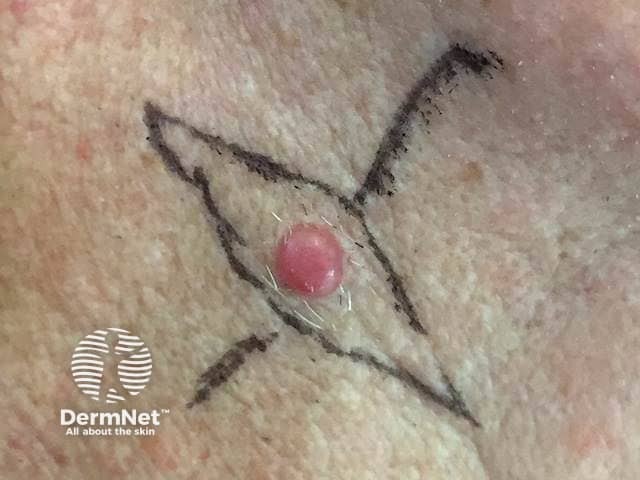 Amelanotic nodular melanoma