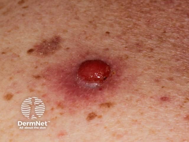 Amelanotic nodular melanoma*