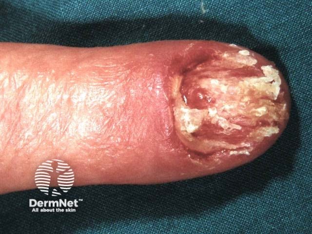 Amelanotic melanoma of the nail unit