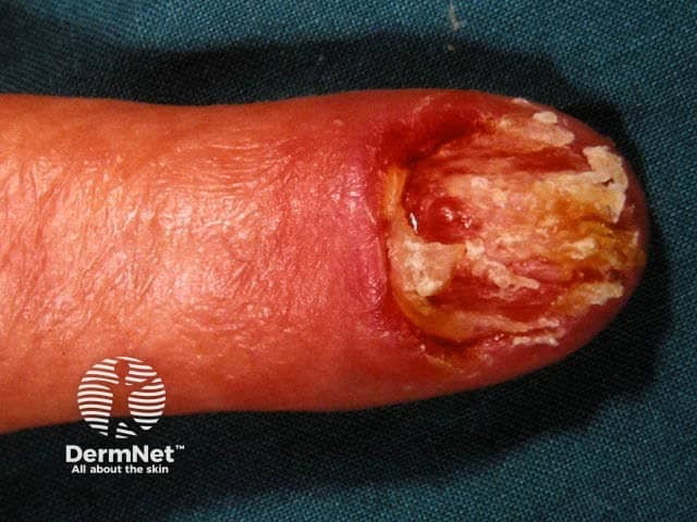 Ungual melanoma