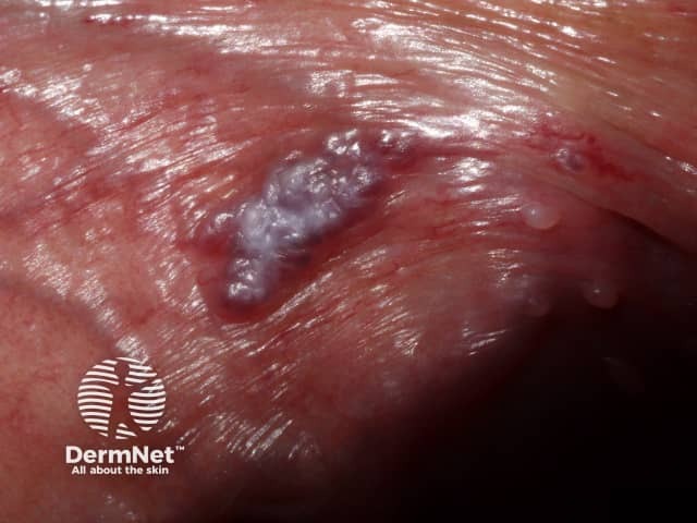 Angiokeratoma of Fordyce on vulva