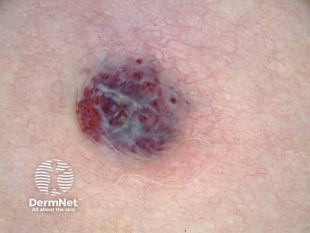 Dermoscopy of angiokeratoma of Fordyce on vulva