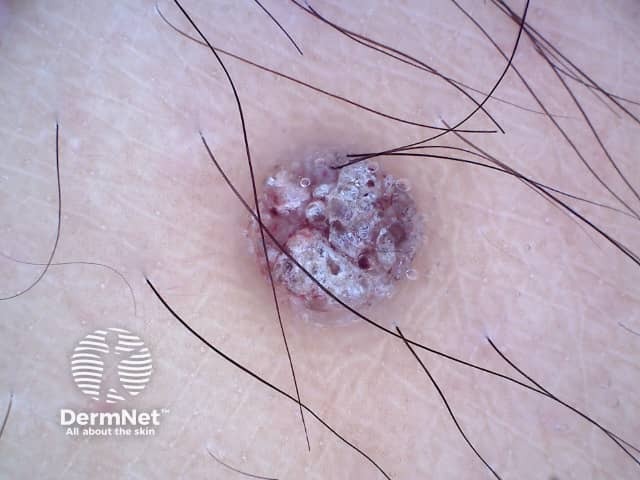 Dermoscopy of angiokeratoma of Fordyce on vulva