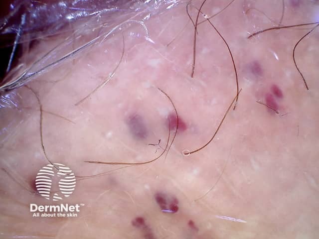 Dermoscopy of angiokeratoma of Fordyce on vulva