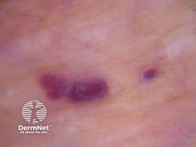 Dermoscopy of angiokeratoma of Fordyce on vulva