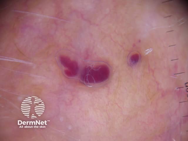 Dermoscopy of angiokeratoma of Fordyce on vulva