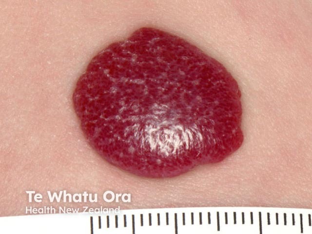 Infantile haemangioma