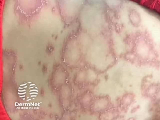 Erythema annulare centrifugum