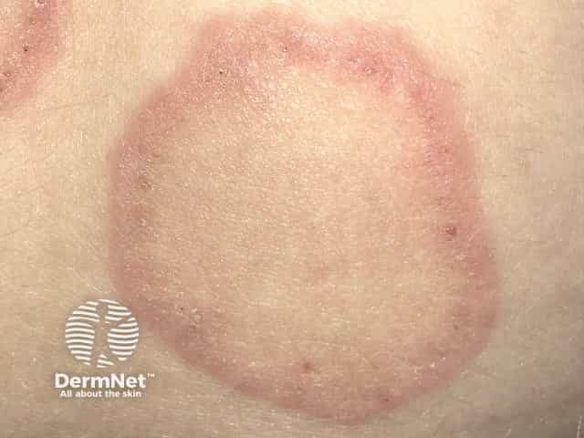 Erythema annulare centrifugum