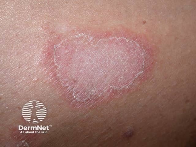 Annular erythema close-up